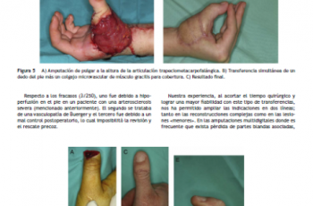 2010 250 trasplantes pie a mano