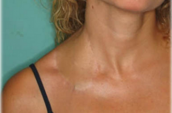 reconstrucción cervical