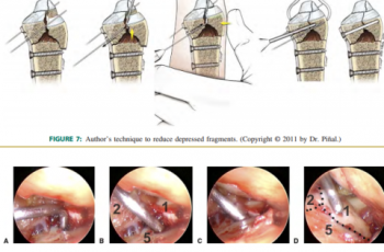 Technical Tips Dry Arthroscopic