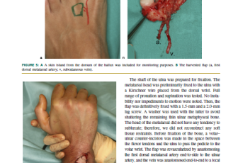 2012 Ulnar Head Reconstruction