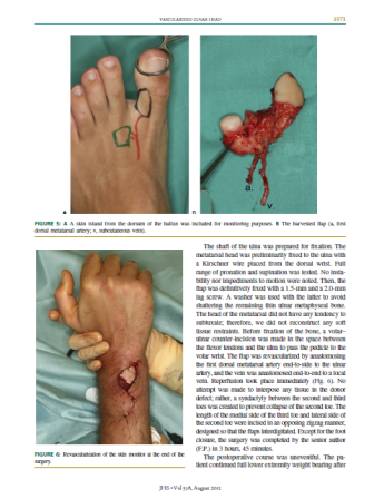 2012 Ulnar Head Reconstruction