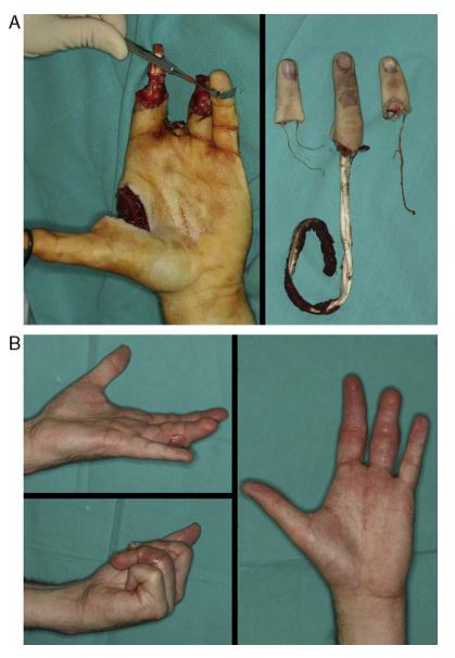 microcirugía reconstructiva en mano con amputaciones, ejemplo 2
