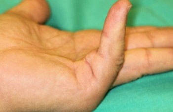 Dr. Del Piñal: “En la artrosis de los dedos de las manos debemos huir de  'tratamientos milagro' y priorizar la función” - Dr. Piñal y Asociados