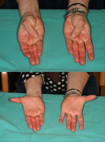 Productos lácteos loseta Impuestos Tratamiento y solución quirúrgica a la artrosis en las manos: dolor y  artrosis de la base del pulgar o trapecio-metacarpiana - Dr. Piñal y  Asociados