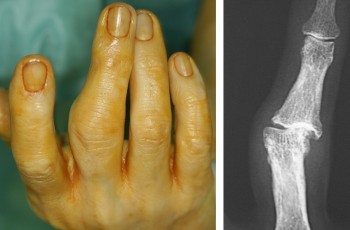 En la imagen superior, paciente con artrosis interfalángica proximal en el dedo medio. Para este perfil de casos, el Dr. Del Piñal aboga por priorizar la función frente a soluciones quirúrgicas, salvo en situaciones de dolor muy intenso y movilidad limitada.