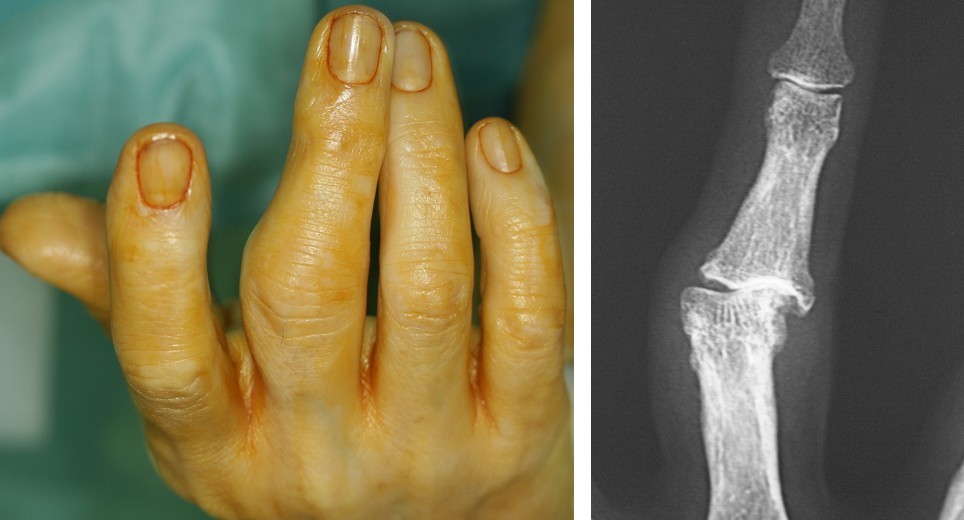 ambulancia Rubicundo frotis Dr. Del Piñal: “En la artrosis de los dedos de las manos debemos huir de  'tratamientos milagro' y priorizar la función” - Dr. Piñal y Asociados