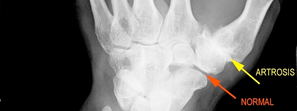 Tratamiento y solución quirúrgica a la artrosis en las manos