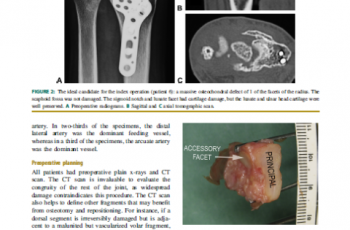 Vascularized graft