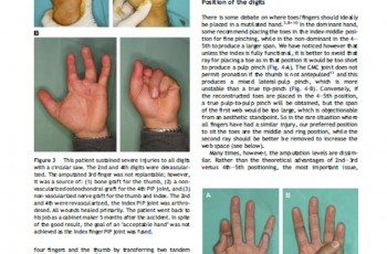 mutilating hand injuries