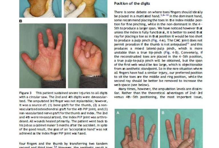 mutilating hand injuries