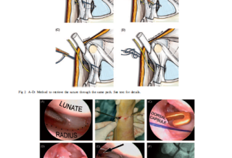 2010 all-inside suturing wrist
