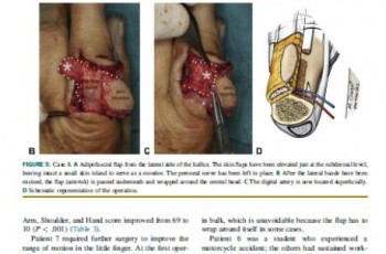 Free Adipofascial Flaps