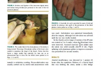 2014 onycho osteo-cutaneous thumbs defects