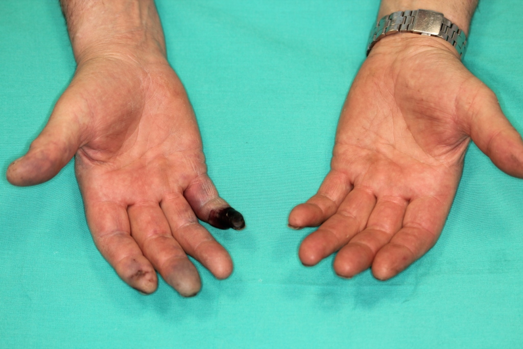La obstrucción del riego sanguíneo provoca la muerte del tejido en la mano derecha del paciente. Un cuadro clínico también conocido como gangrena seca.