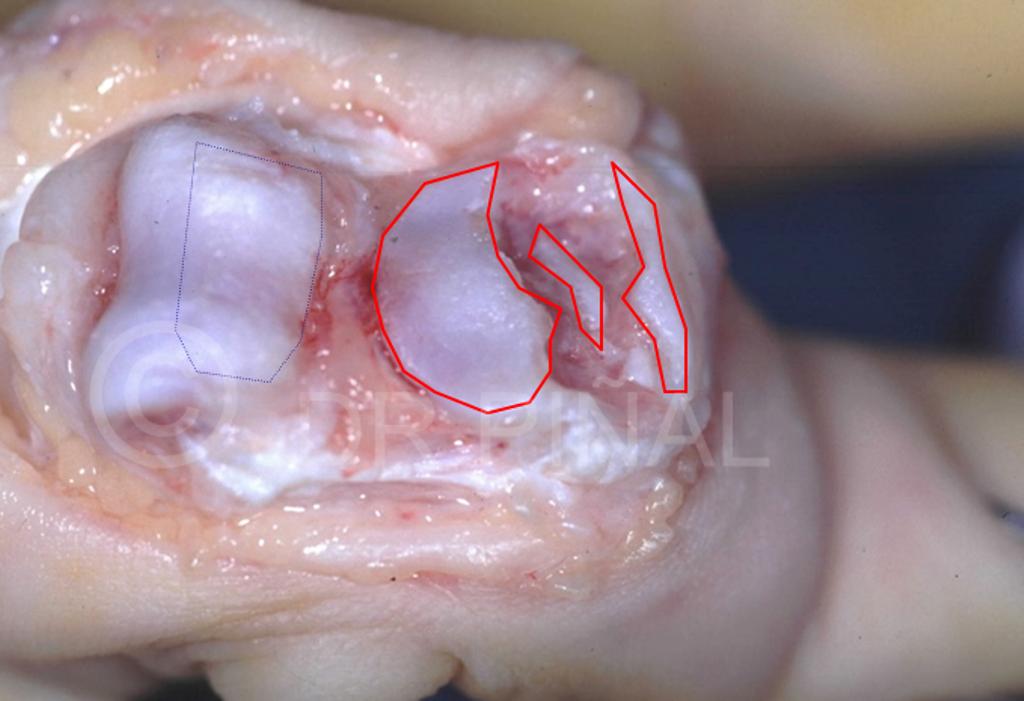 Cirugía (1). En la imagen, puede observarse el abordaje quirúrgico del problema. El dedo girado, dado la vuelta, permite ver los fragmentos articulares desplazados (rodeados en rojo).