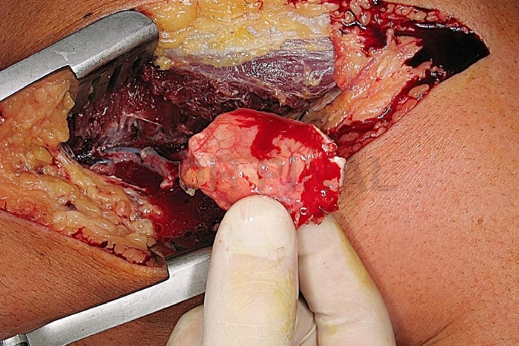 Cirugía (1). Extracción del colgajo de periostio femoral. En la imagen se observa en detalle su extraordinaria vascularización.
