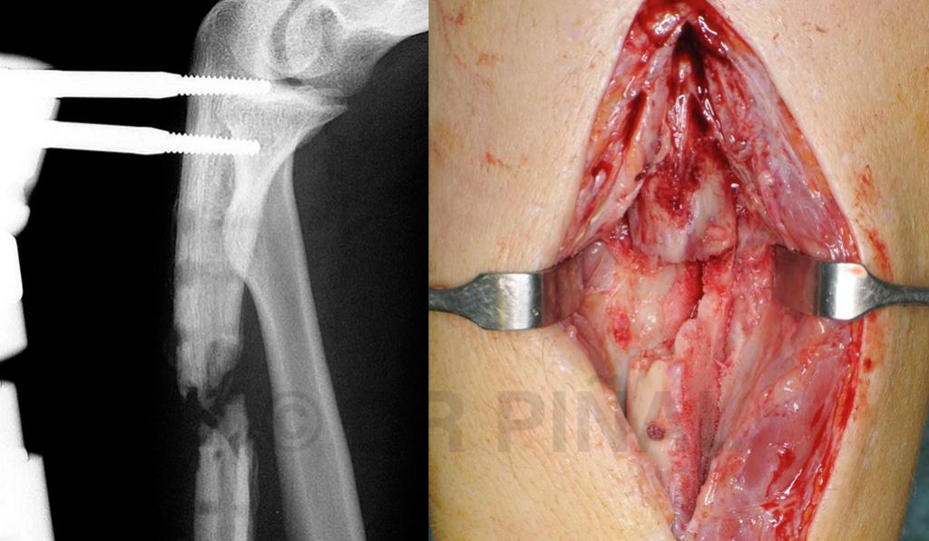 El área fracturada está ‘sostenida’ con una fijación externa. La imagen permite observar el daño óseo y el efecto de la osteomielitis sobre el cubito.
