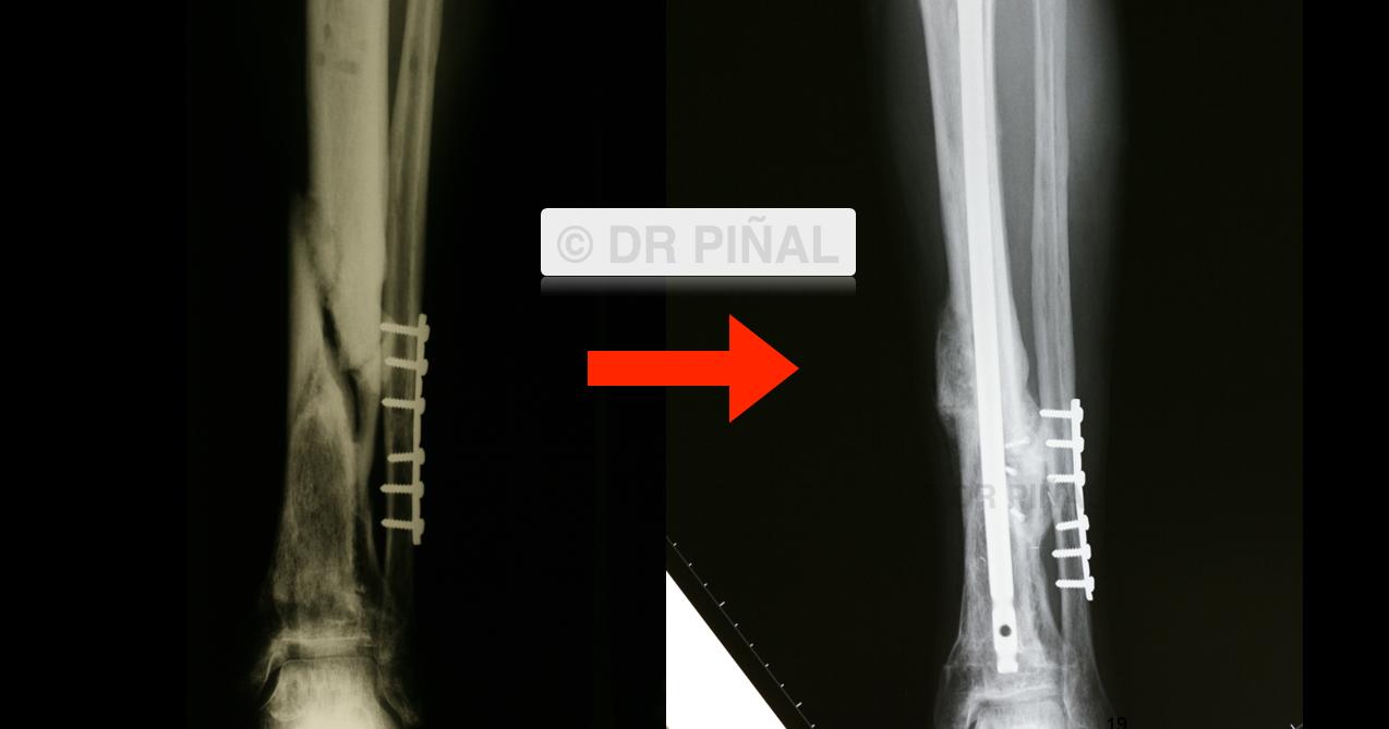 La imagen, que contrapone la situación pre y postoperatoria (derecha), nos permite observar en detalle la ‘reparación’ de la fractura, así como la aparición de masa ósea en la zona afectada gracias al injerto de periostio femoral.