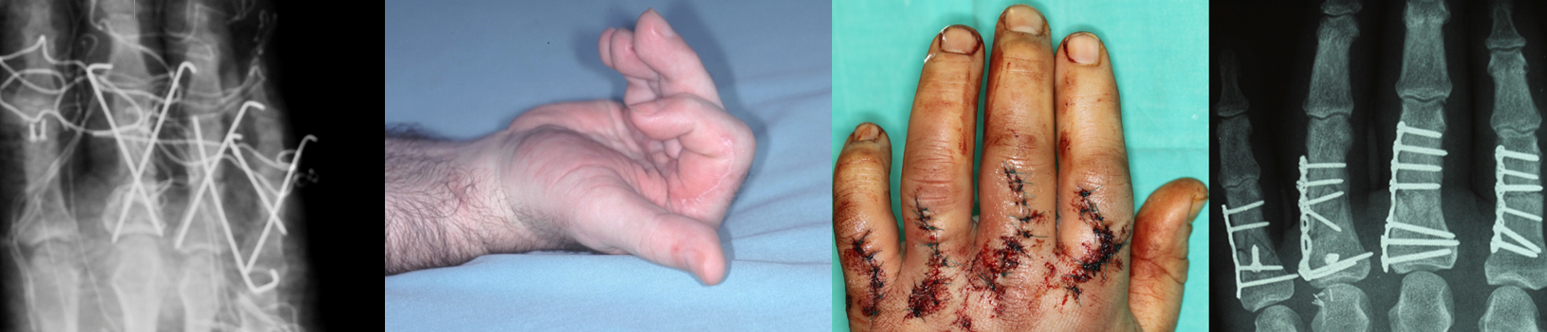 Techniques discarded by Dr. Piñal in similar cases