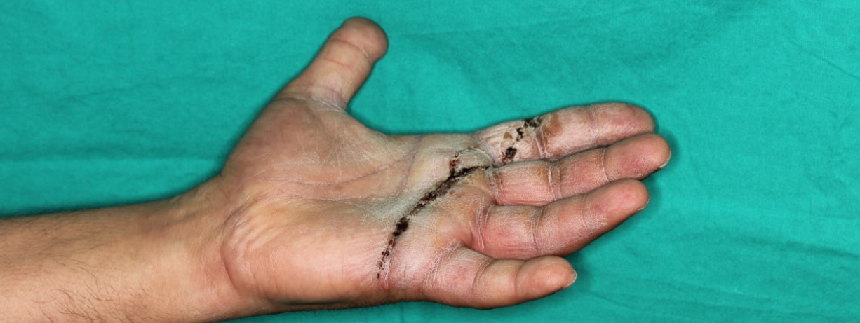 Heridas por aplastamiento y movilidad a la semana de la intervención del Dr. Piñal