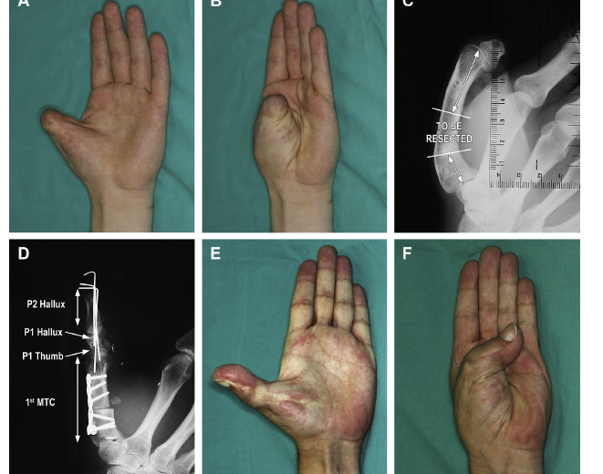 Primary thumb reconstruction. This 35-year-old sustained at the age of 20 a traumatic thumb amputation that was managed by
lengthening. He had been seeking a better alternative ever since. (C, D) The author offered to straighten and
shorten the metacarpal, and at the same time to carry out a trimmed toe hallux transfer.