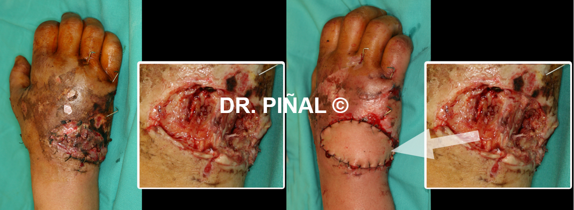 Debridement and autologous graft of vascularized skin