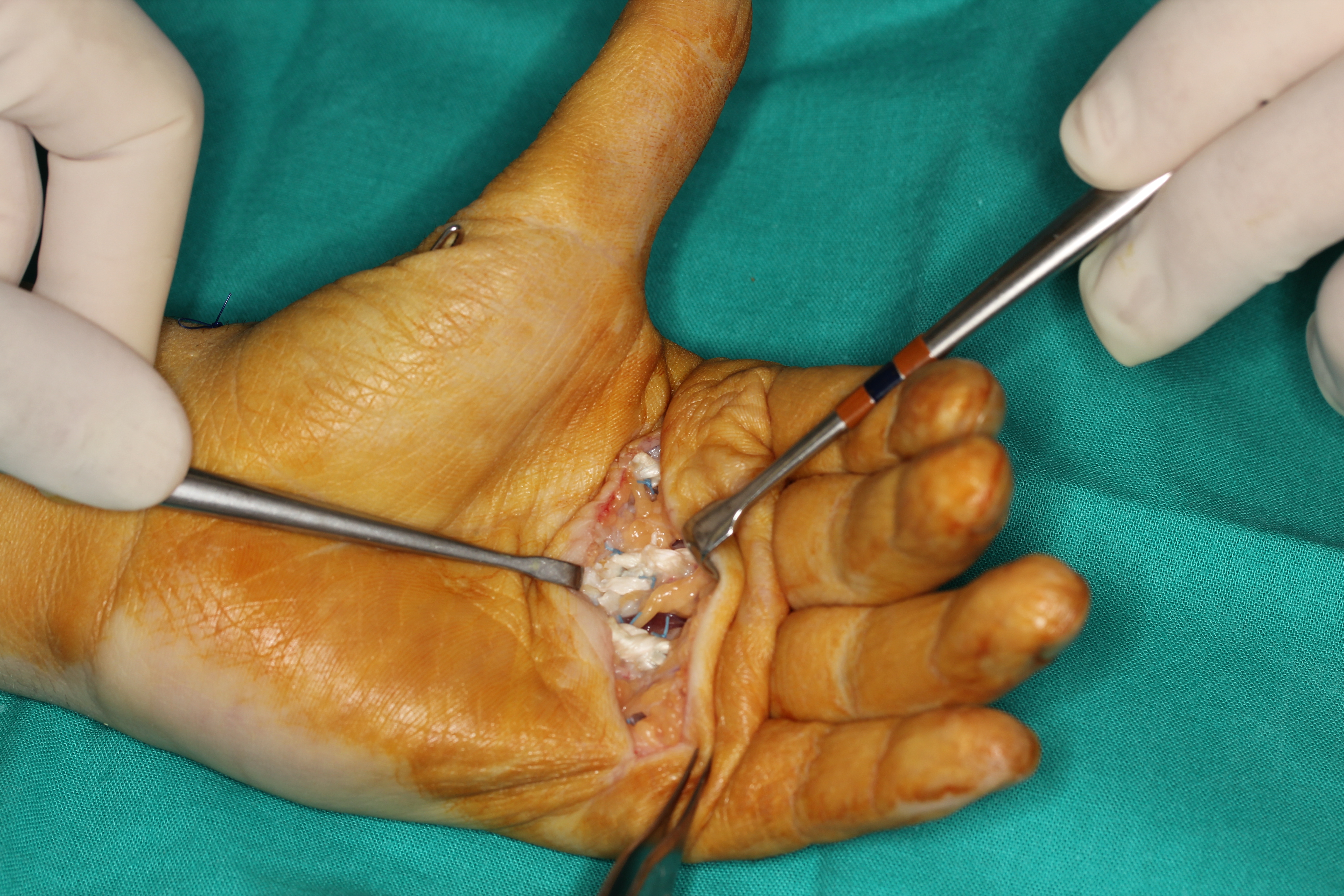 Zancolli's lasso procedure in paralytic hand