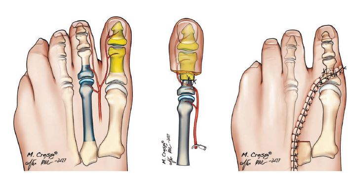 Switching-Two-Toe-Transfer procedure 