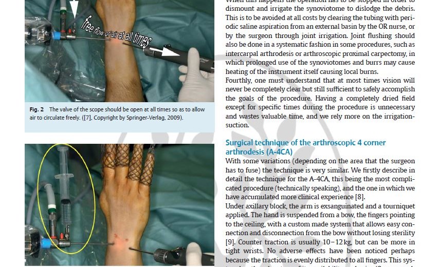 2014 Dry Arthroscopic Partial Wrist Arthrodesis_01_201901202