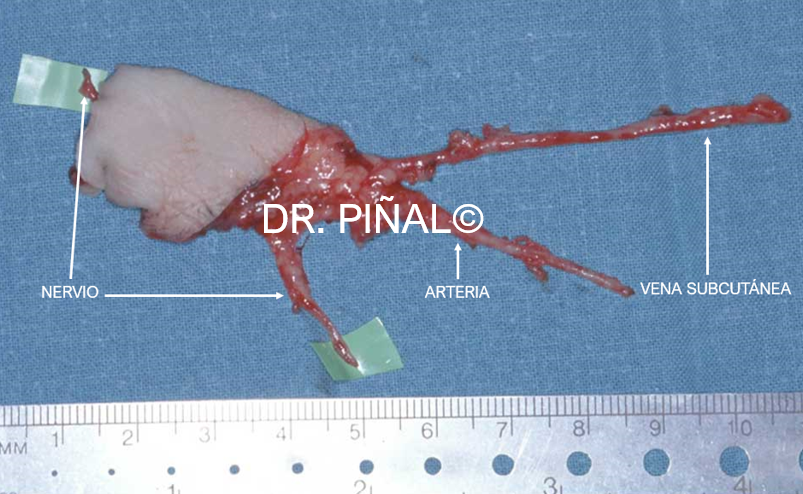 Colgajo libre neurocutáneo vascularizado 