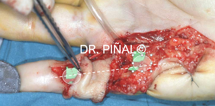 Microsurgical connections of the digital nerve 