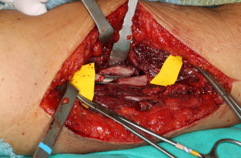 Colgajo de periostio vascularizado en pseudoartrosis de humero_01_20201124