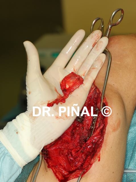 Periosteal microvascular flap