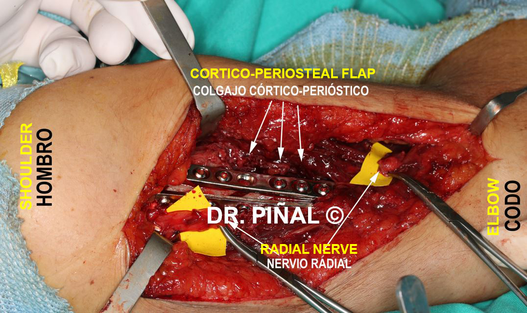 Transferred cortico-periosteal flap