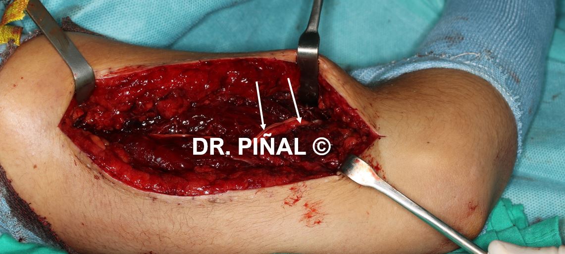 Microsurgical repair of the radial nerve