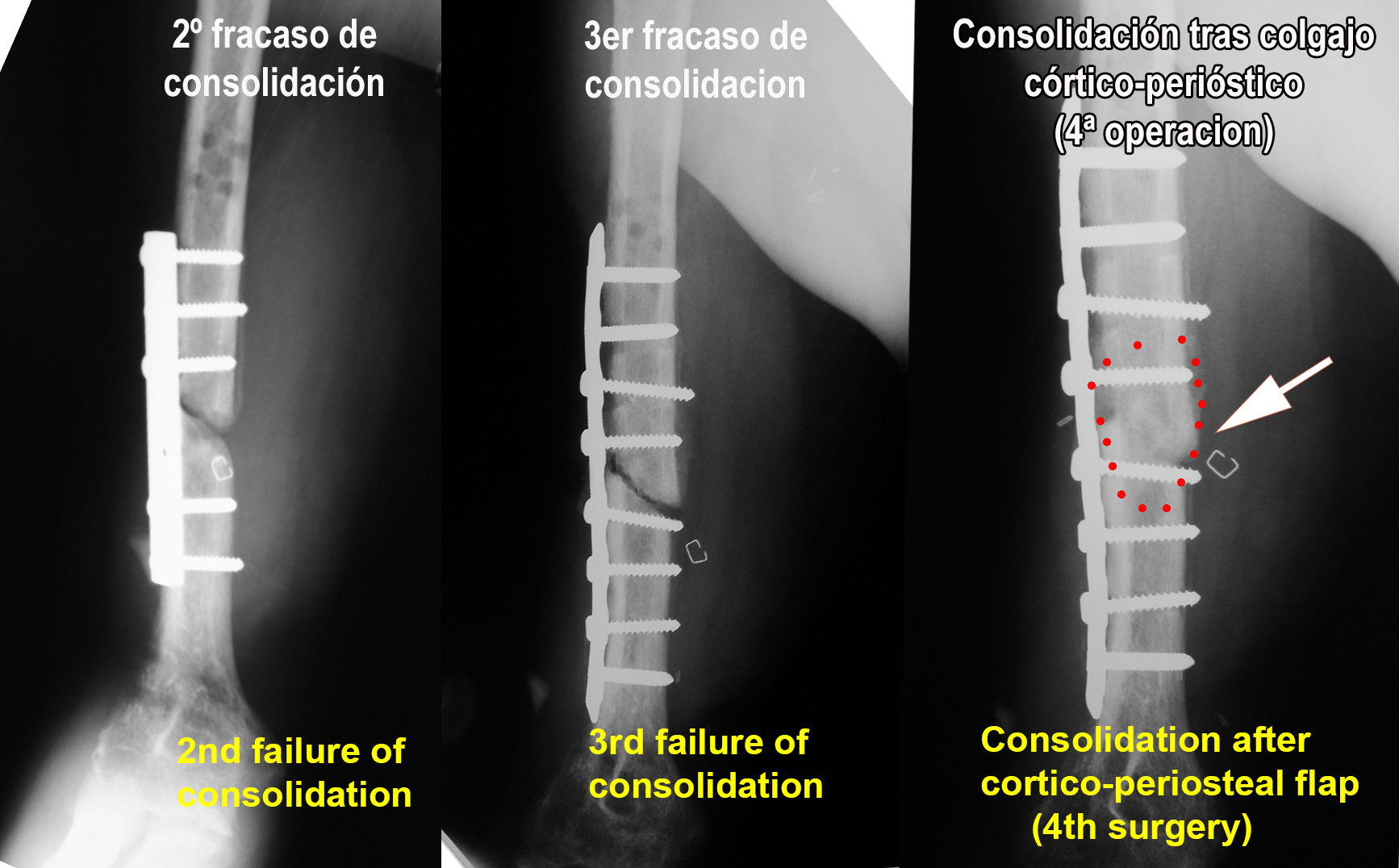 Consolidation after cortico-periosteal flap