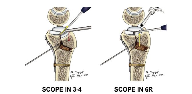 Placement of the arthroscope 