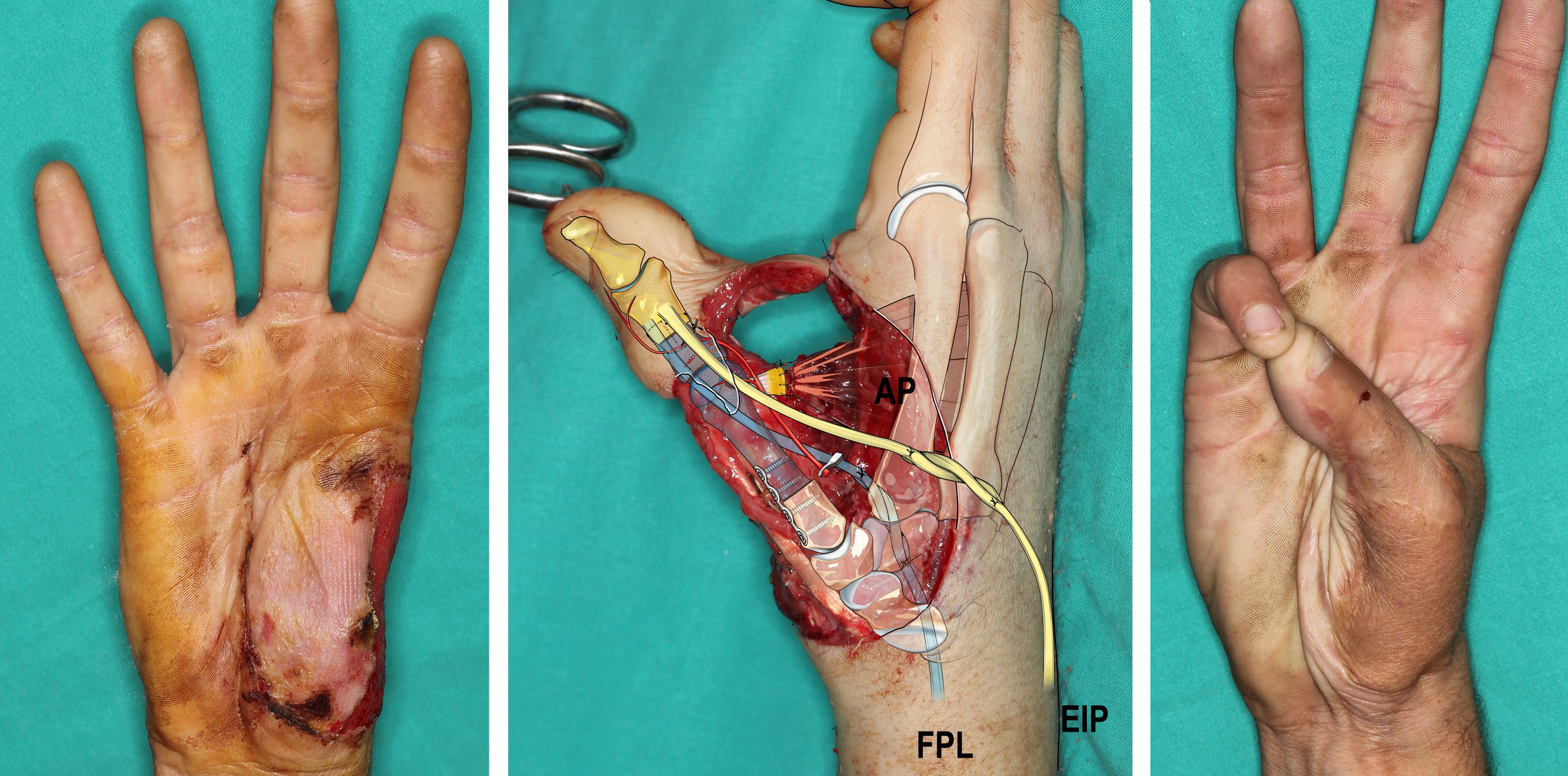 Thumb reconstruction in the subacute period