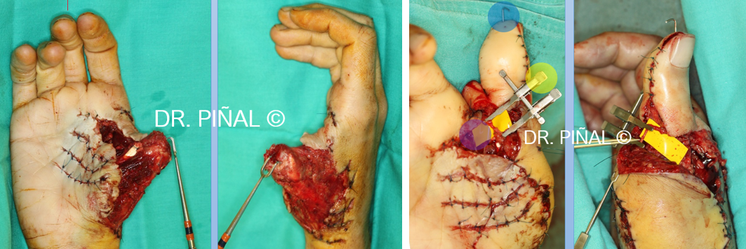Microsurgical thumb reconstruction 