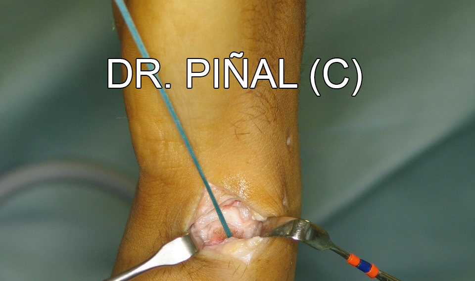 Vista exterior de la sutura 