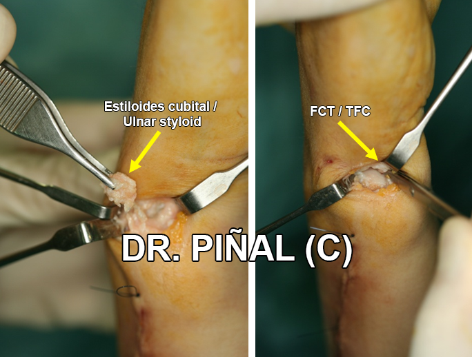 Removal of the ulnar styloid